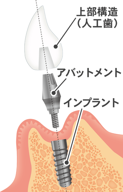 歯の装着