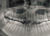 CT(1)