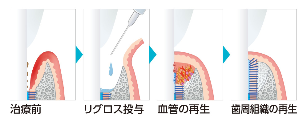 リグロスによる歯周組織の再生